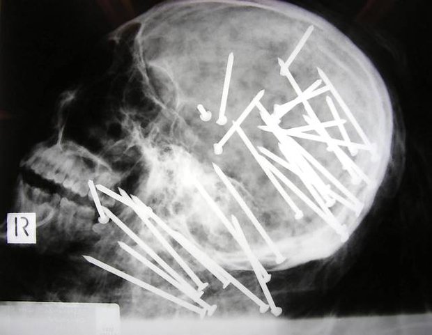 Police handout image of an X-ray showing multiple nails embedded in the skull of 27-year-old Chen (Anthony) Liu